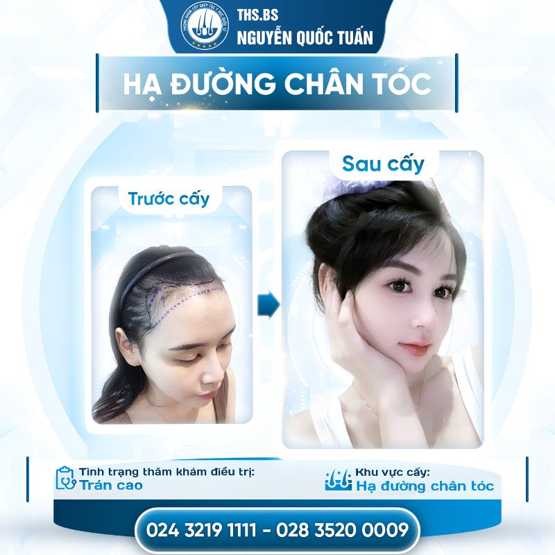 Kết quả cấy tóc nữ tại Phòng Khám Cấy Tóc Y Học Quốc Tế 