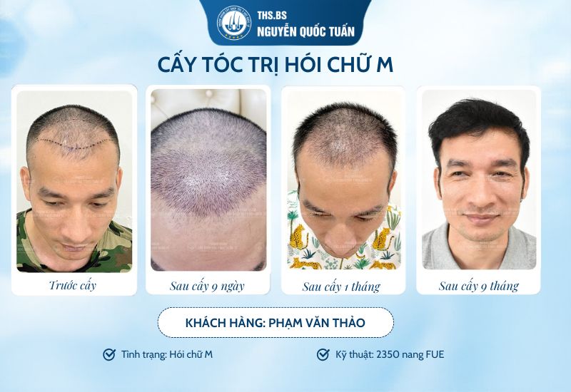 Điều trị hói chữ M ở đâu uy tín?