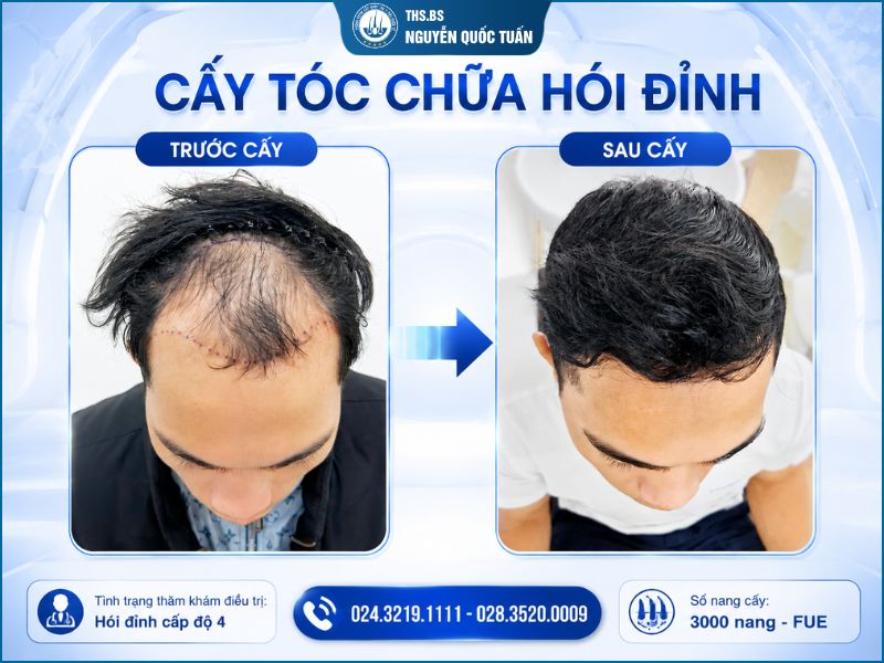 Điều trị rụng tóc tại Phòng khám Cấy ghép tóc Y học Quốc tế 