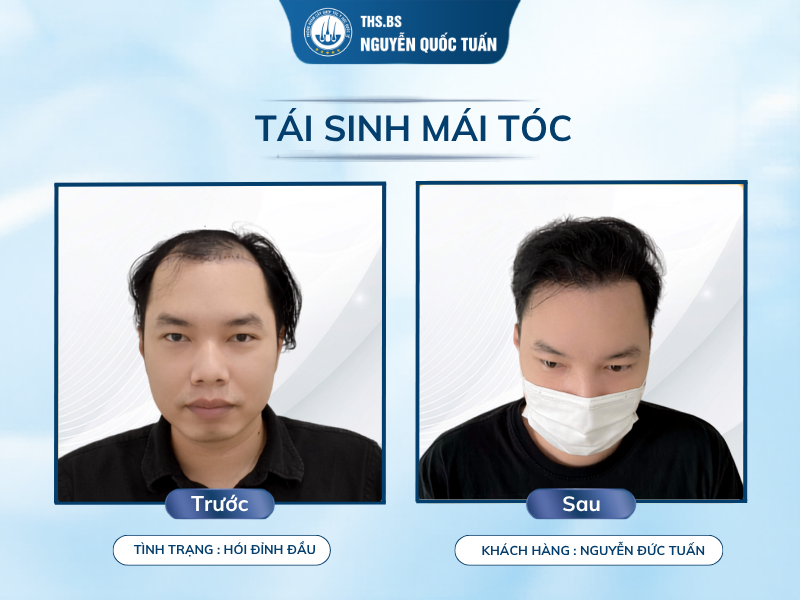 Hiệu quả của cấy tóc trị hói đỉnh đầu