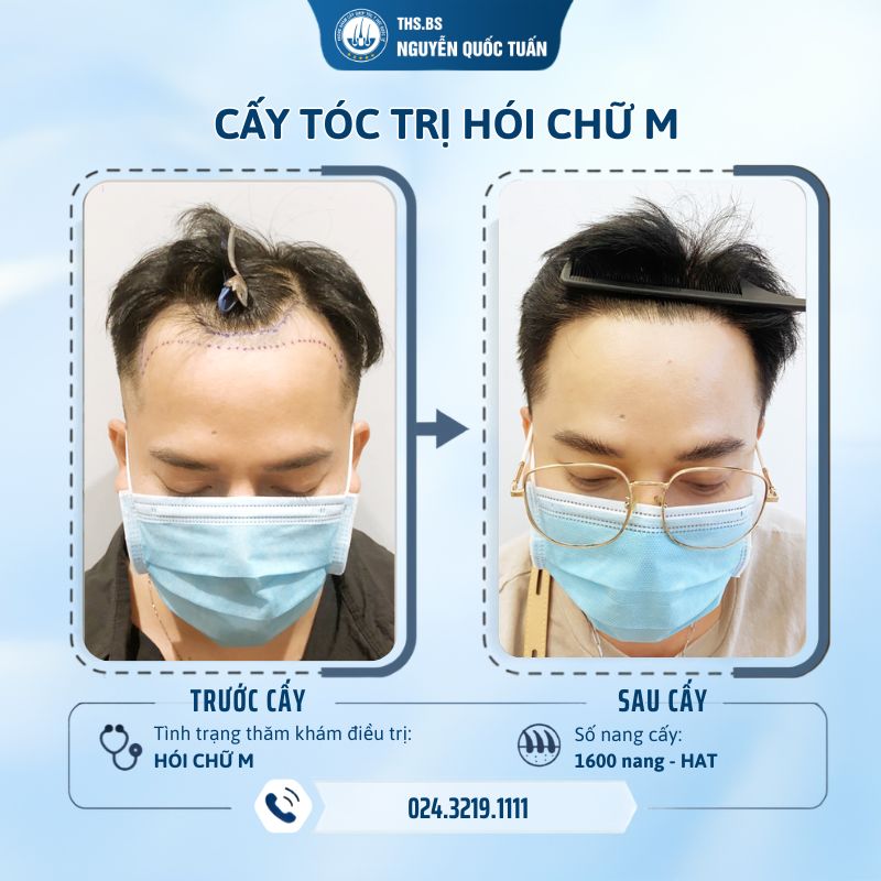 Hiệu quả trị hói chữ M bằng phương pháp cấy tóc tự thân  