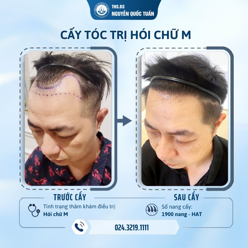 Cấy tóc giữ được bao lâu? Mốc thời gian thực tế sau cấy 