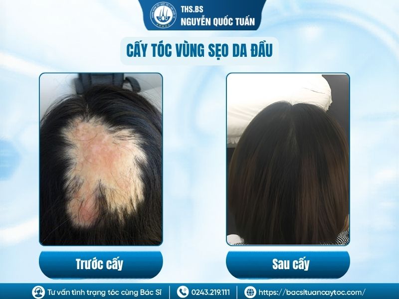 Hiệu quả cấy tóc cho vùng bị sẹo ở da đầu