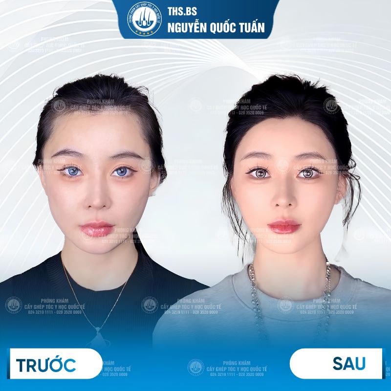 Hiệu quả thẩm mỹ cấy tóc sợi dài