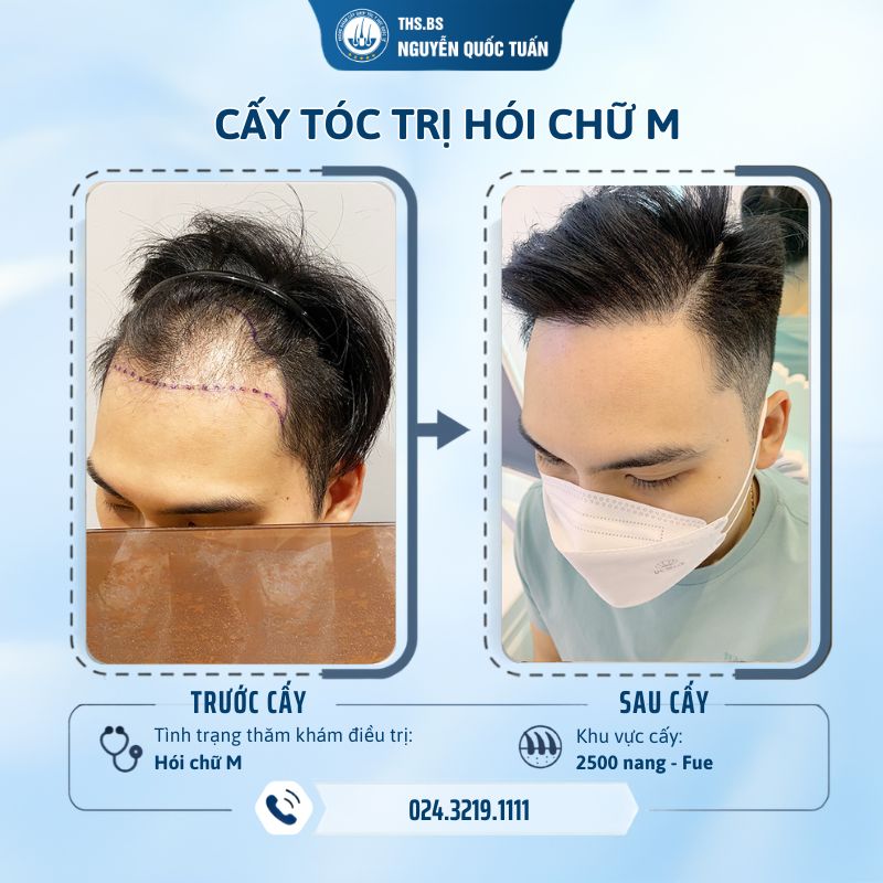 Đánh giá thực tế của khách hàng sau khi cấy tóc trị hói chữ M
