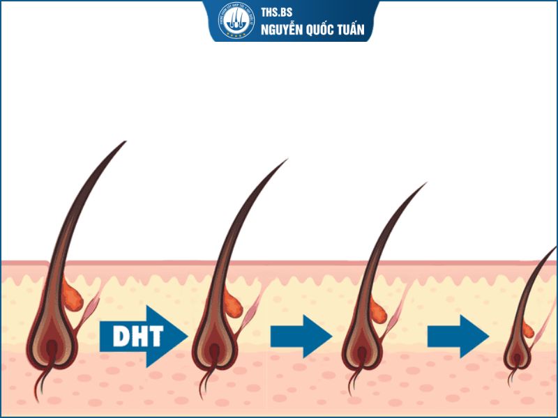 Di truyền khiến nang tóc dễ bị ảnh hưởng như thế nào 