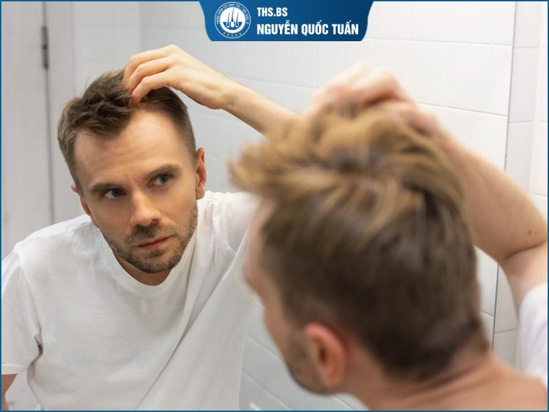 Hói chữ M ảnh hưởng tới gương mặt như thế nào?