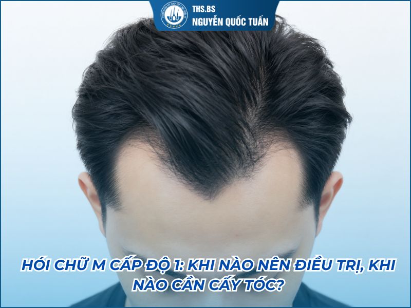 hói chữ m cấp độ 1