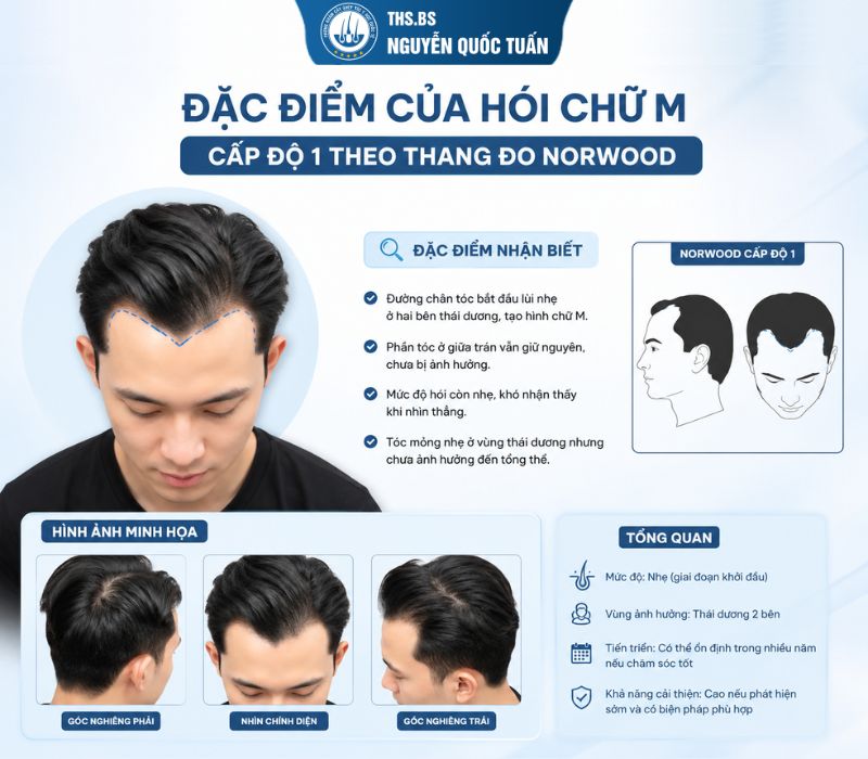 Hói chữ M cấp độ 1 theo thang đo Norwood