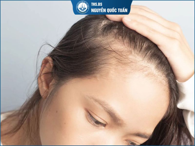 Hói chữ M nữ chỉ cần đổi kiểu tóc có cải thiện được không? 