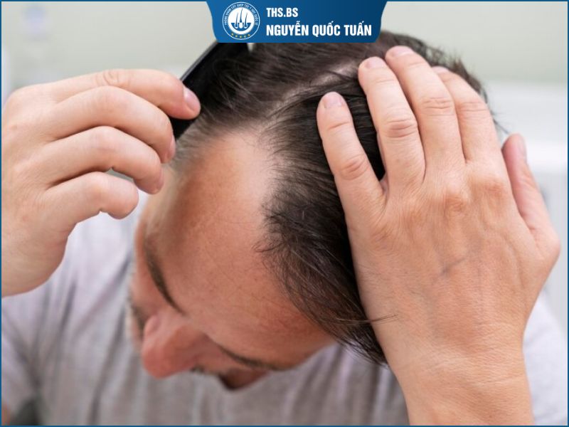 Các yếu tố khác có thể thúc đẩy quá trình hói chữ M 