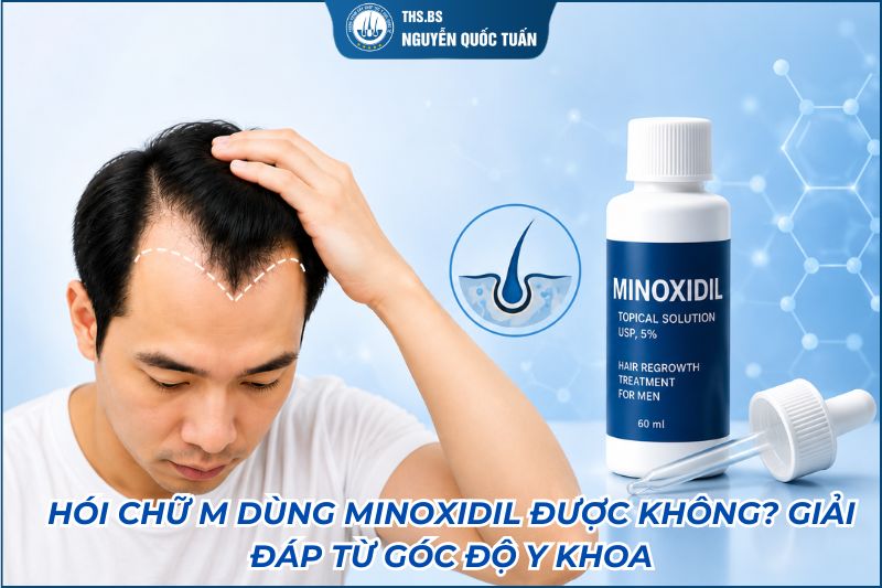 Hói chữ M dùng Minoxidil được không
