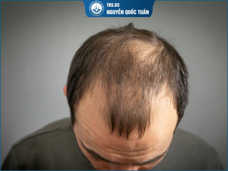 Ai dễ bị hói chữ M 