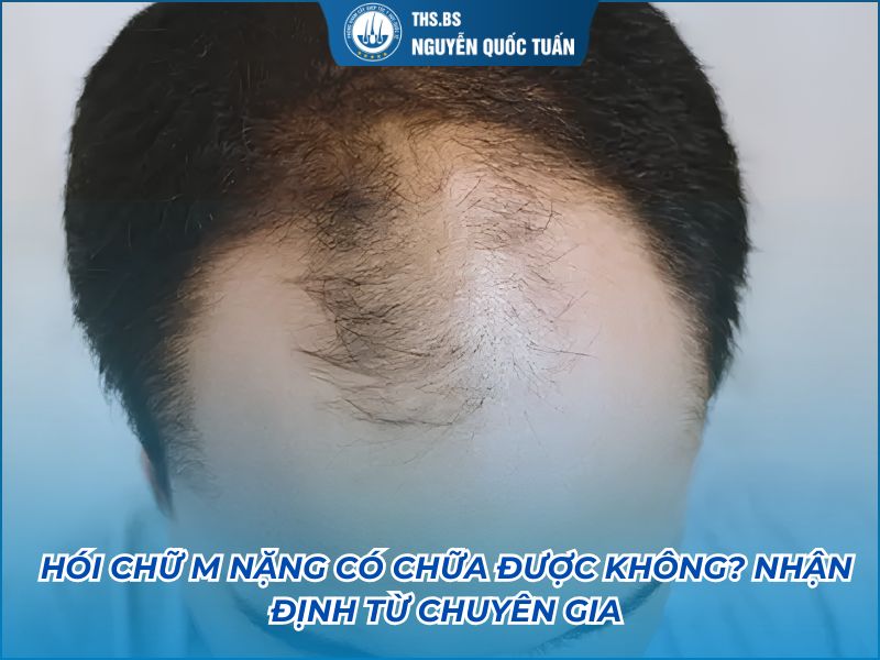 hói chữ m nặng có chữa được không