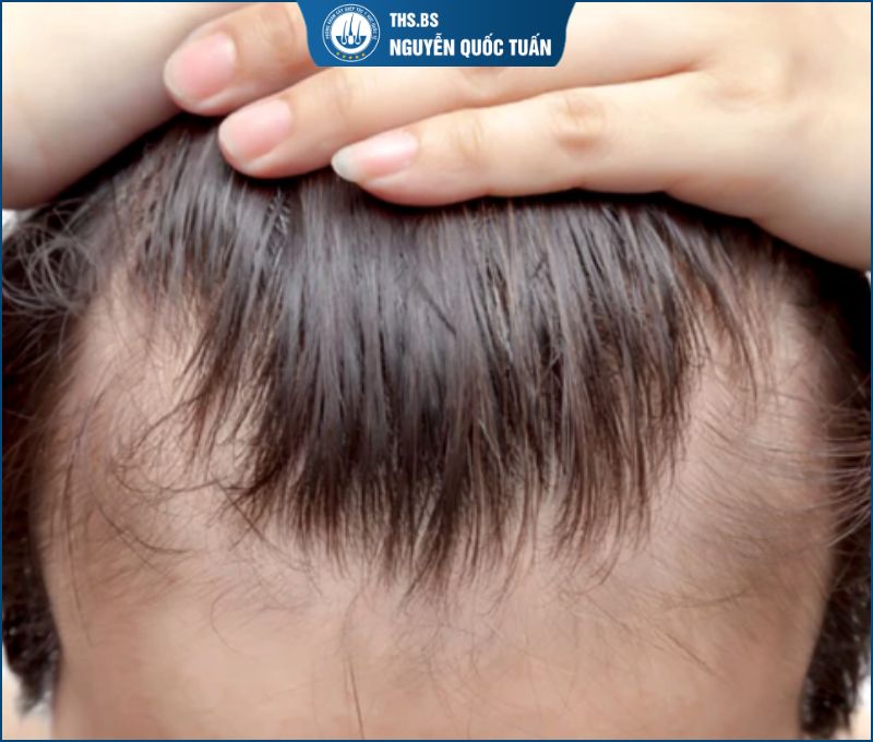  Khi nào kiểu tóc không còn đủ để che hói chữ M 