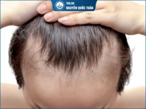 hói chữ M phải làm sao