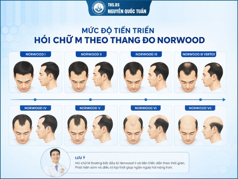 Phân loại mức độ tiến triển hói chữ M theo thang đo Norwood