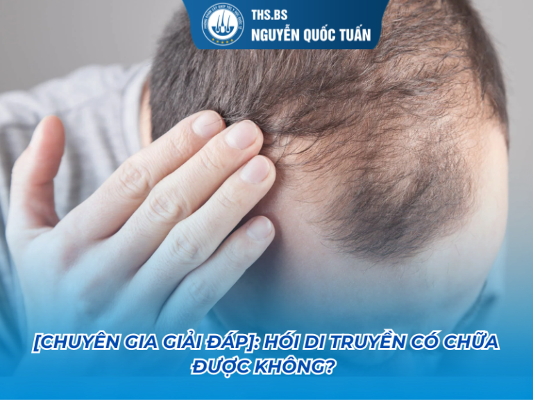hói di truyền có chữa được không
