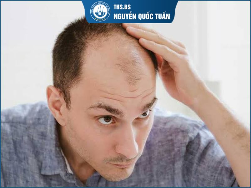 Điều gì quyết định khả năng điều trị hói di truyền