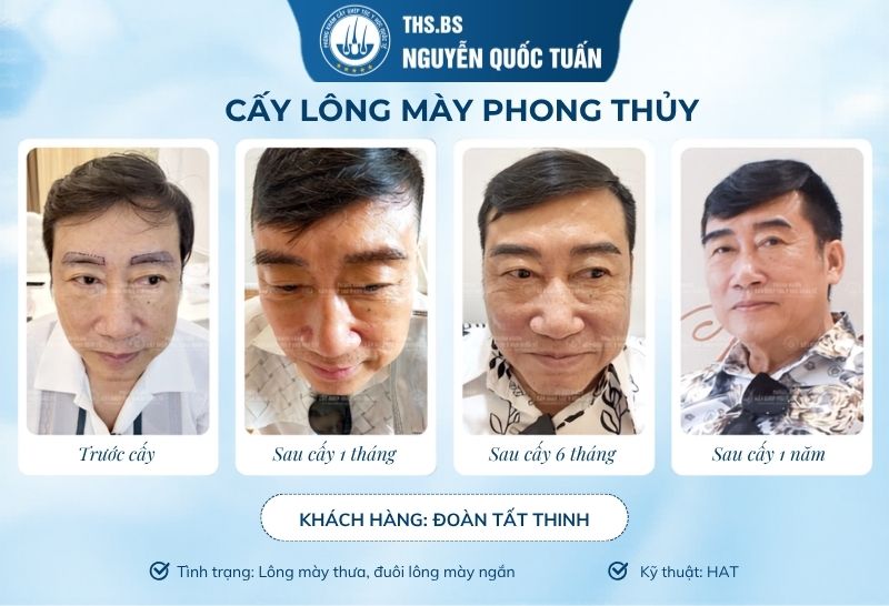 Cấy lông mày có thực sự giúp thay đổi diện mạo và phong thủy?  