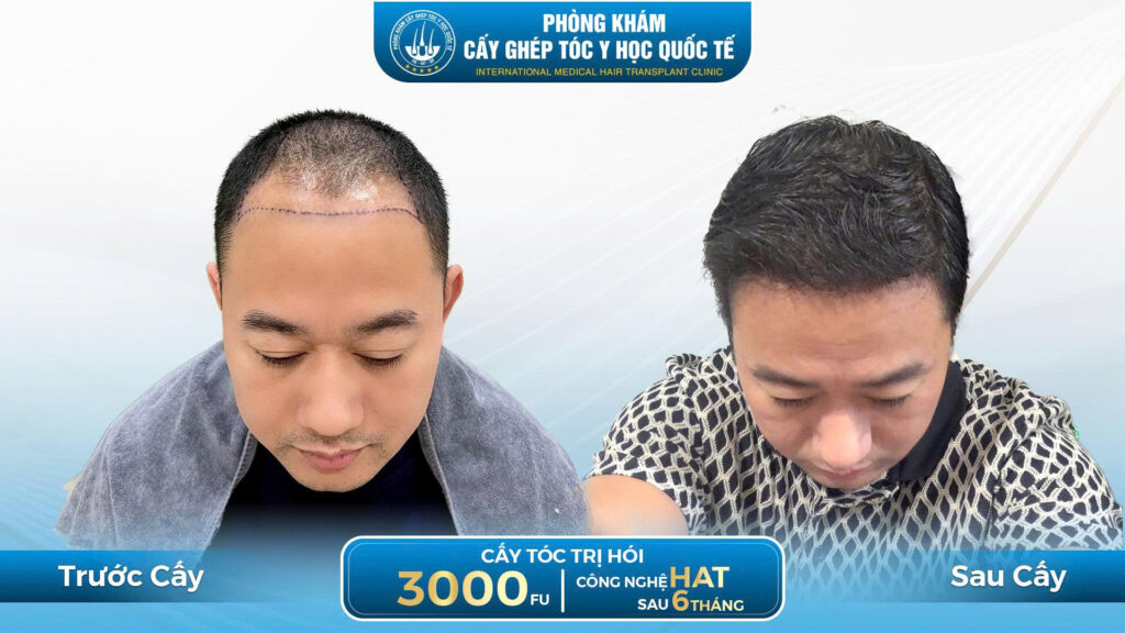 Hiệu quả cấy tóc sau cấy công nghệ HAT 