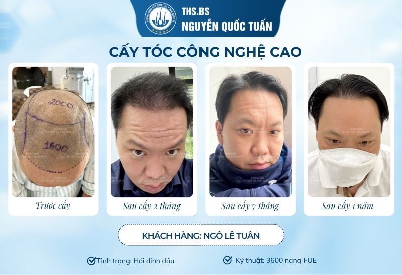 Điều trị hói di truyền ở đâu uy tín và an toàn hiện nay?