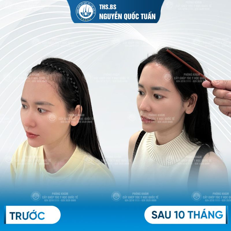 Hiệu quả sau khi cấy tóc tự thân Y Học Quốc Tế