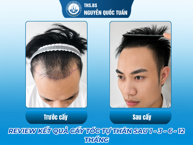 ket-qua-cay-toc-tu-than
