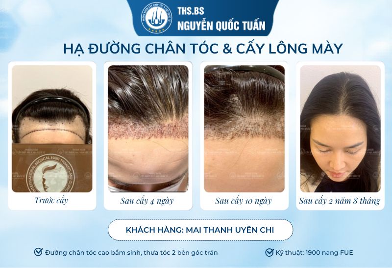 Kết quả sau 2 năm cấy tóc tự thân