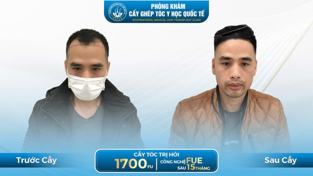 Kết quả của công nghệ cấy tóc tự thân