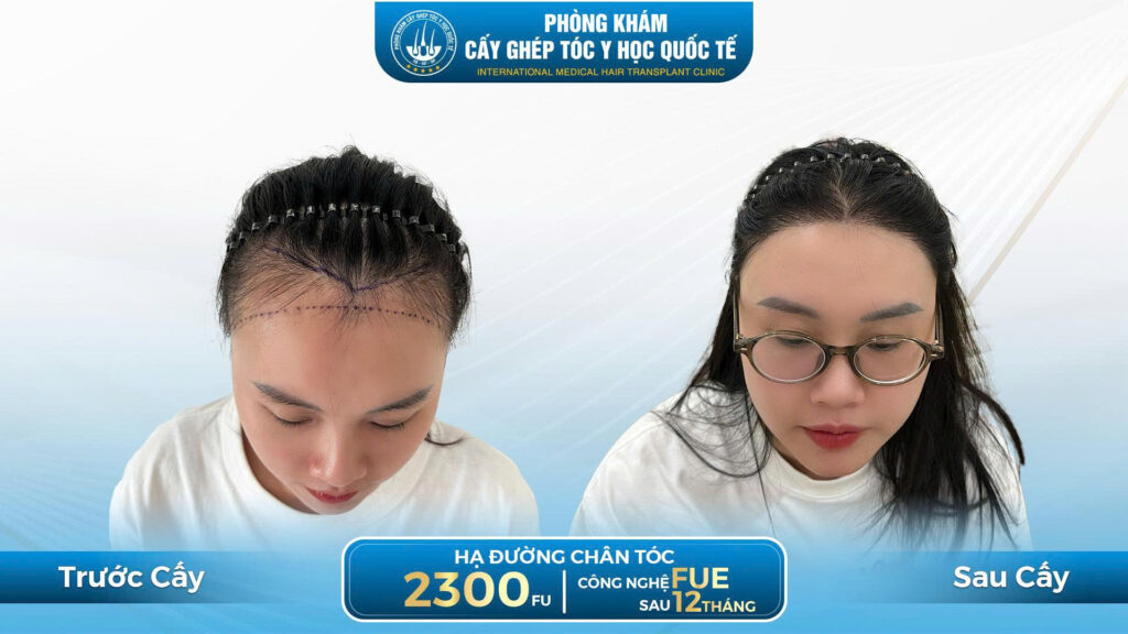 Cấy tóc tự thân