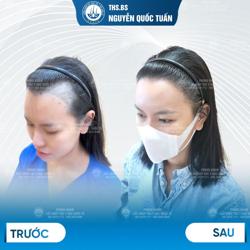 Hiệu quả cấy tóc tại Phòng Khám Cấy Tóc Y Học Quốc Tế