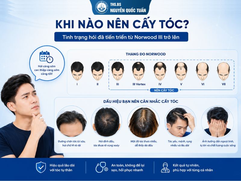 Khi nào nên cấy tóc
