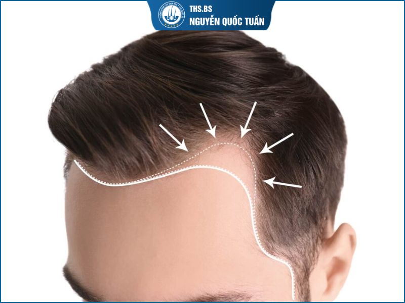 Đường chân tóc lún sau thành hói chữ M