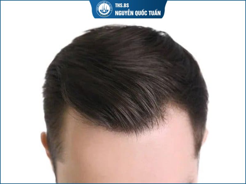 Kiểu tóc nào không phù hợp với nam bị hói chữ M? 
