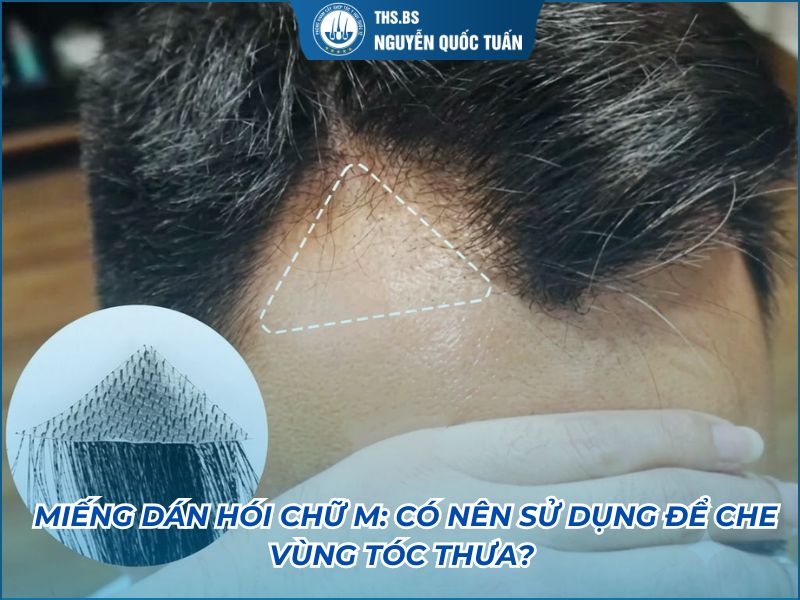 miếng dán hói chữ m