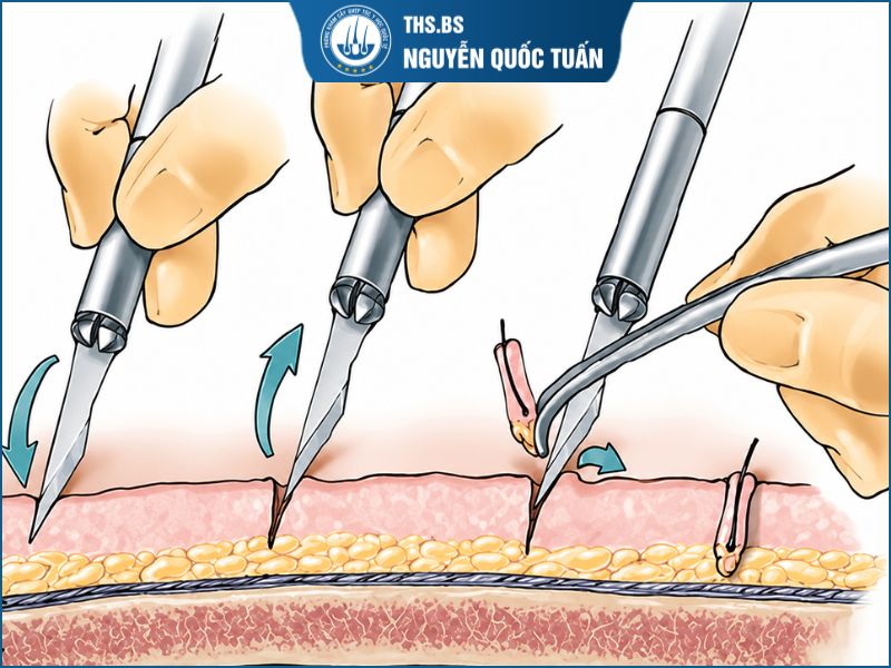 Nguyên lý hoạt động của kỹ thuật cấy tóc