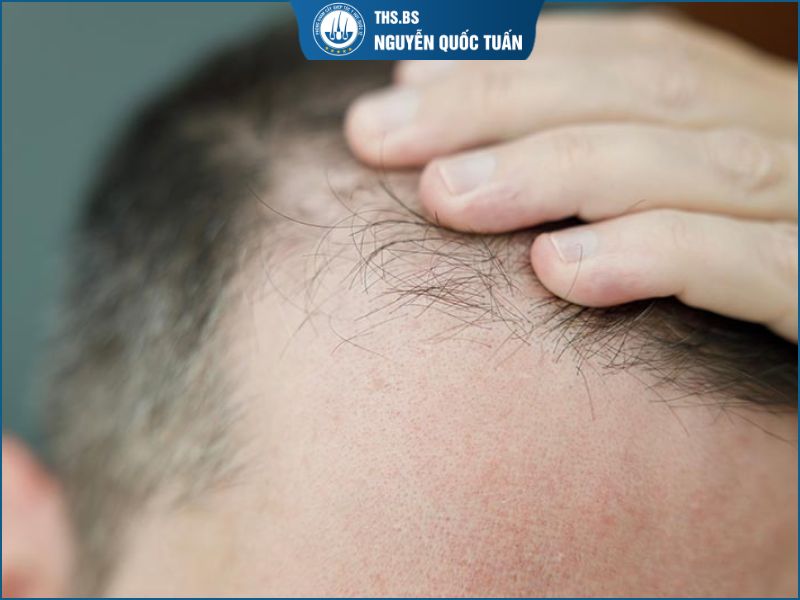 Làm sao nhận biết hói chữ M giai đoạn đầu? 