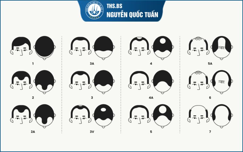 Cách nhận biết hói chữ M nhẹ qua thang đo Norwood 