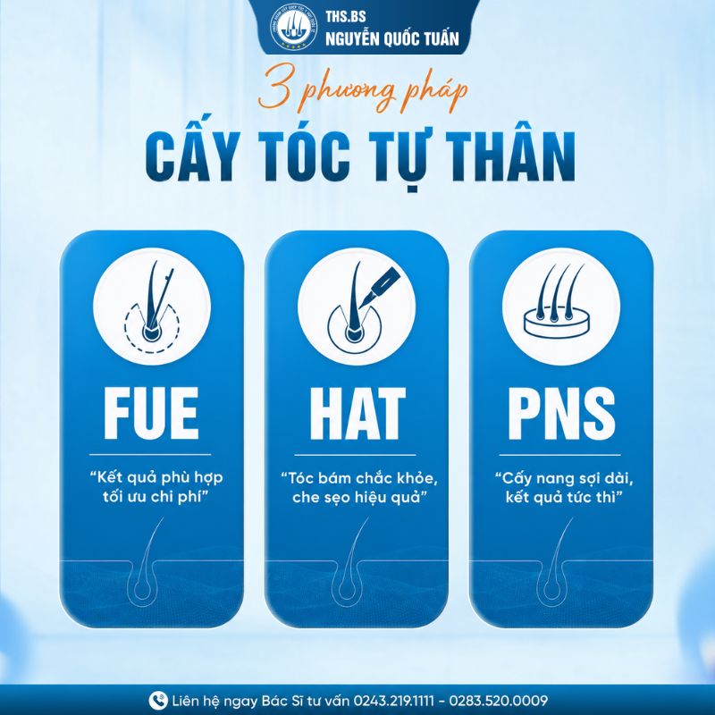 3 công nghệ cấy tóc tự thân tại Y Học Quốc Tế 