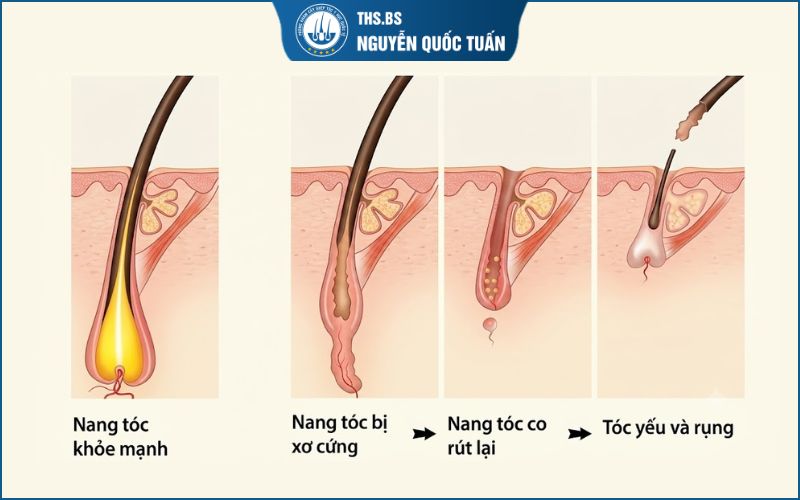 Quá trình rụng tóc theo thời gian