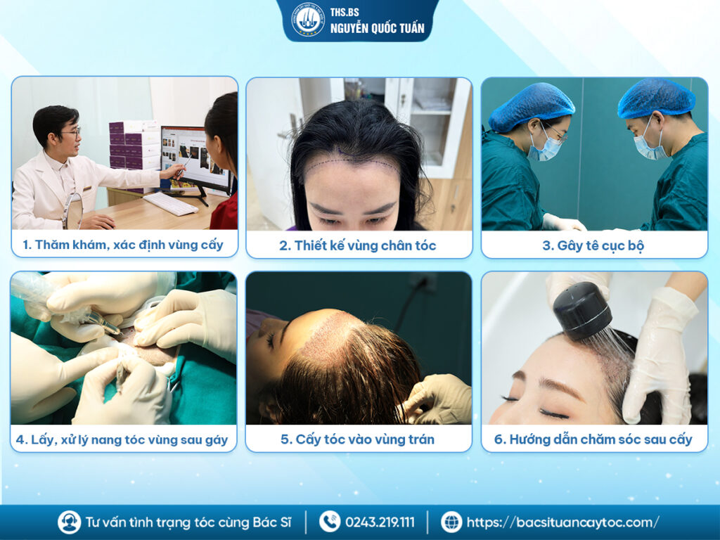  Quy trình cấy tóc tự thân chi tiết tại Y Học Quốc Tế