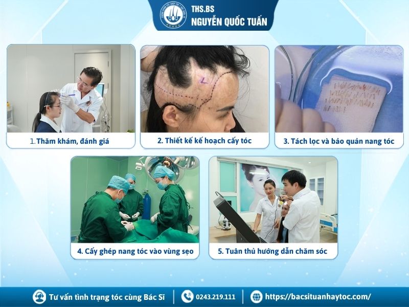 Quy trình cấy tóc trên sẹo chuẩn y khoa