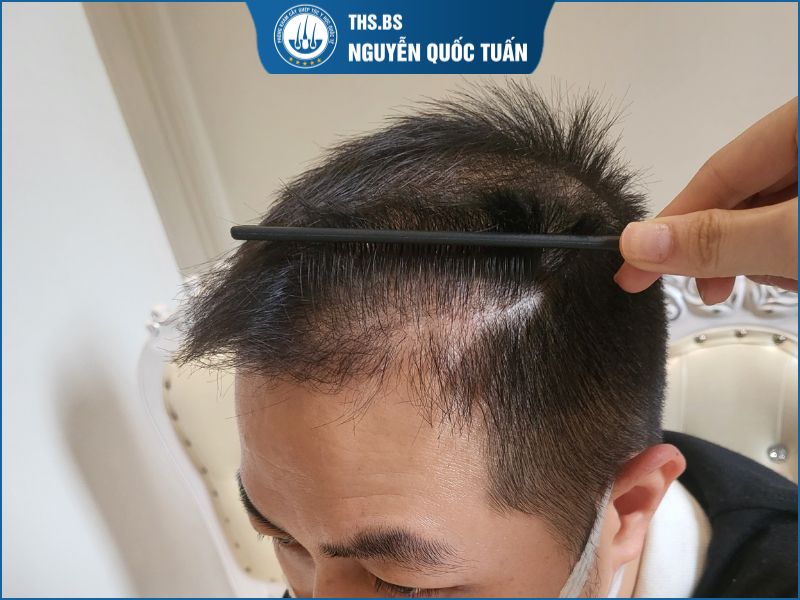 Giai đoạn rụng tóc thay thân sau khi cấy tóc