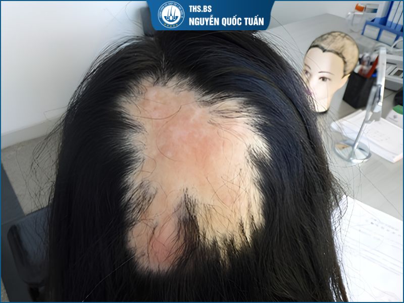 Sẹo da đầu hình thành như thế nào