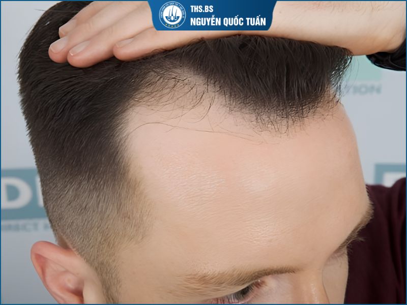 Lý do nam giới bị hói chữ M nên chọn kiểu tóc phù hợp 