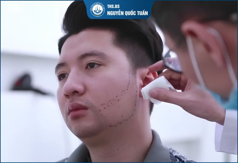 Thăm khám, thiết kế dáng râu phù hợp 