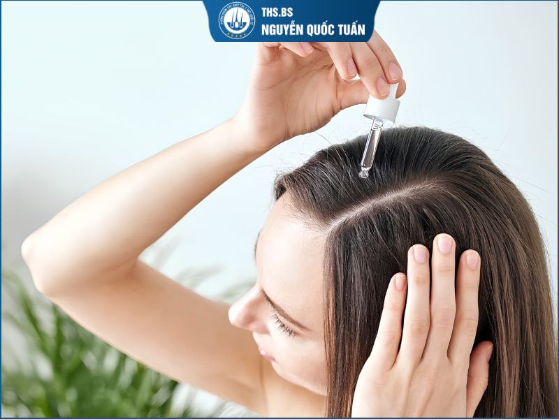 Hói chữ M ở nam nên cải thiện bằng phương pháp nào