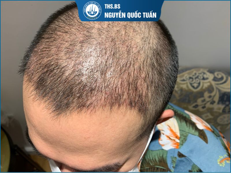Tóc sau cấy 1 tháng như thế nào là bình thường
