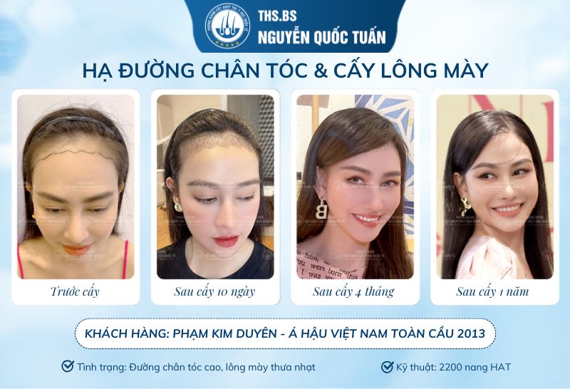Sau cấy tóc bao lâu thấy được sự thay đổi rõ rệt?